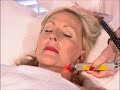 Beautylight Dark Circles Beautylight Dark Circles