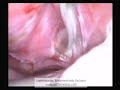 Laparoscopic Endometriosis Excision (Mild) Laparoscopic Endometriosis Excision (Mild)