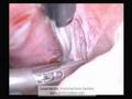 Laparoscopic Endometriosis Excision (Mild)