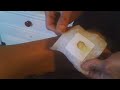Wheelchair style - Nasty Skin Burn 2nd Degree Burn wound care (Part 1) - L1 injury 3-29-12