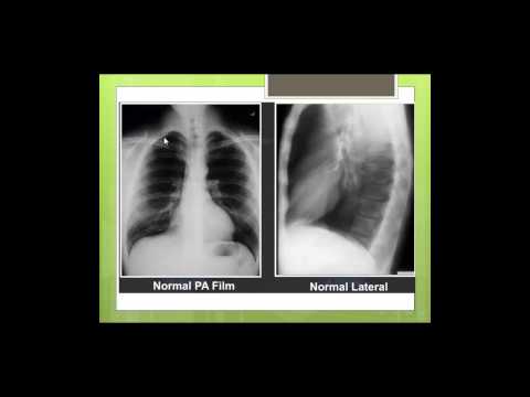 how to measure cardiomegaly on cxr