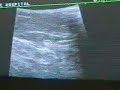 Dr Kirksey Varicose Vein Treatment Penn Presby