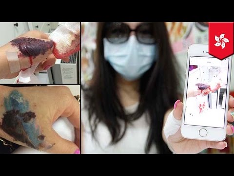 hand - A Hong Kong woman named Wendy underwent a laser procedure to remove a tattoo on her hand in May, but ended up with hideous scar as a result. She went to Windland Medical beauty clinic in Mong...