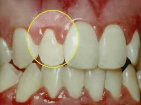 how to treat gum infection