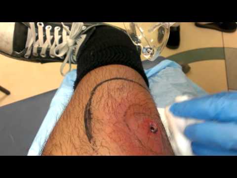 how to treat open boil wound