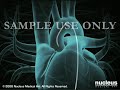 Heart Animation:  Coronary Angiography (Cardiac Catheterization)