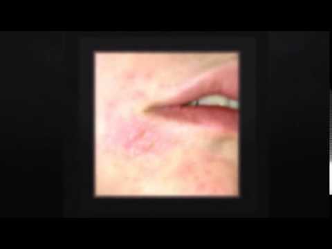 how to use jojoba oil for eczema