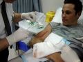 18 Stitches - \"Just a Scratch\"