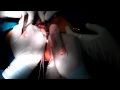 Vaginal VesicoVaginal Fistula Repair Part 1 By Prof. Hazem Sammour