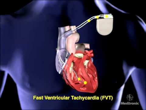 how to perform overdrive pacing