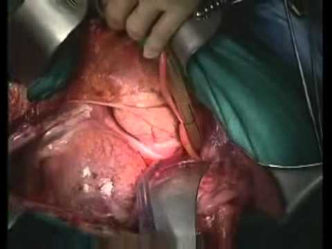 how to repair aortic aneurysm