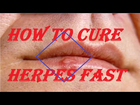 how to treat herpes