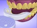 iWhite Light Activated Teeth Whitening Kit iWhite Light Activated Teeth Whitening Kit