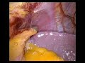 laparoscopic Gastric banding laparoscopic Gastric banding