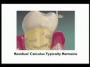 Healthier Tooth and Gums Healthier Tooth and Gums