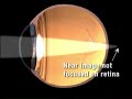 Presbyopia Warning Signs ? Eye Doctors of Washington DC