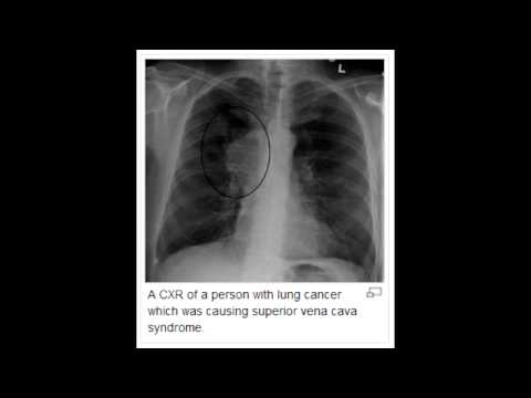 how to treat svc syndrome