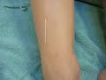 Acupunctuur bij Retropatellaire chondropathie IOCOB Acupunctuur bij Retropatellaire chondropathie IOCOB