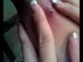 Infected Hair Follicle.3g2