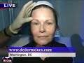 Cosmetic Breakthrough: Thermage