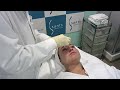 El Peeling fenol