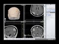 Occipital Meningioma surgical removed with Craniotomy