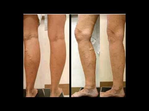 how to avoid varicose veins