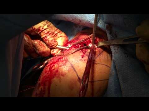 Coracoclavicular ligament reconstruction