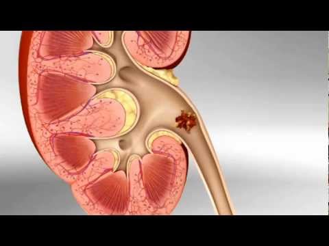 how to help kidney stone pain