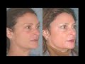Fraxel repair CO2 laser - Min S. Ahn, MD FACS