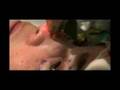 Fraxel repair CO2 laser - Min S. Ahn, MD FACS