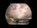 Explanation and demonstration of Arthroscopic SubAcromial Decompression to treat Rotator Cuff Impingement and Rotator Cuff Tears