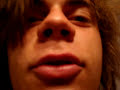 Biggest Pimple Ever