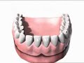 Dental Implants Sonicare