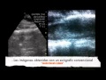 Intramedullary Lump Examination During Surgery By Pocket-Sized Ultrasound