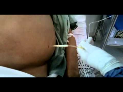 how to perform paracentesis