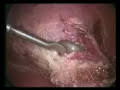 Endometriose de bexiga