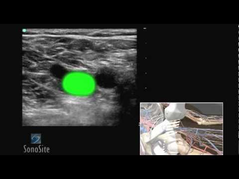 how to perform dvt ultrasound
