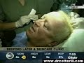 Hair Transplant - Dr.Cotterill performs surgery on CityTV