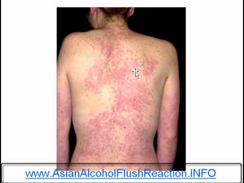 how to get rid of asian glow