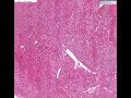 Histopathology Kidney--Wilms tumor Histopathology Kidney--Wilms tumor