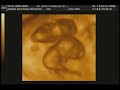USG 4D GEMELAR 9 SEMANAS