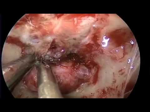 how to perform endoscopy