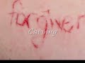 Self Injury Statistics Injury Statistics