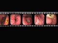 Gastric Ulcer Presentation Film 2
