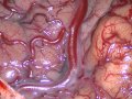 Mixed Endoscopic And Surgical Management Of The Cavernous AVF. Mixed Endoscopic And Surgical Management Of The Cavernous AVF.
