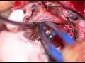 Suboccipital transtentorial approach for hemangioblastoma located on superior cerebellar surface
