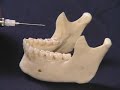 Mandibular Anesthesia - Inferior Alveolar Nerve Block