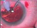 Cataract surgery Cataract surgery
