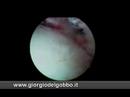 impingement tessuti molli impingement tessuti molli